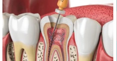 root canal procedure